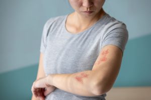 herpes zoster