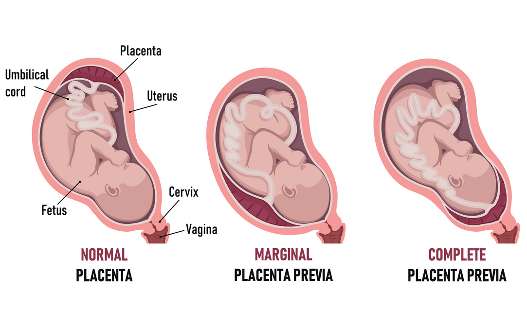 Kondisi Plasenta Previa: Penyebab, Gejala dan Penanganannya
