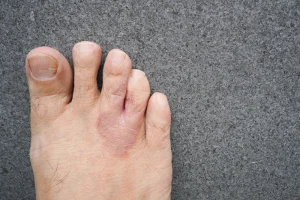 Bahaya Kutu Air di Musim Hujan! Ciri dan Cara Mengobatinya