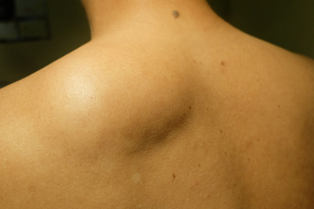 Lipoma dan Mengatasinya dengan Liposuction Surgery