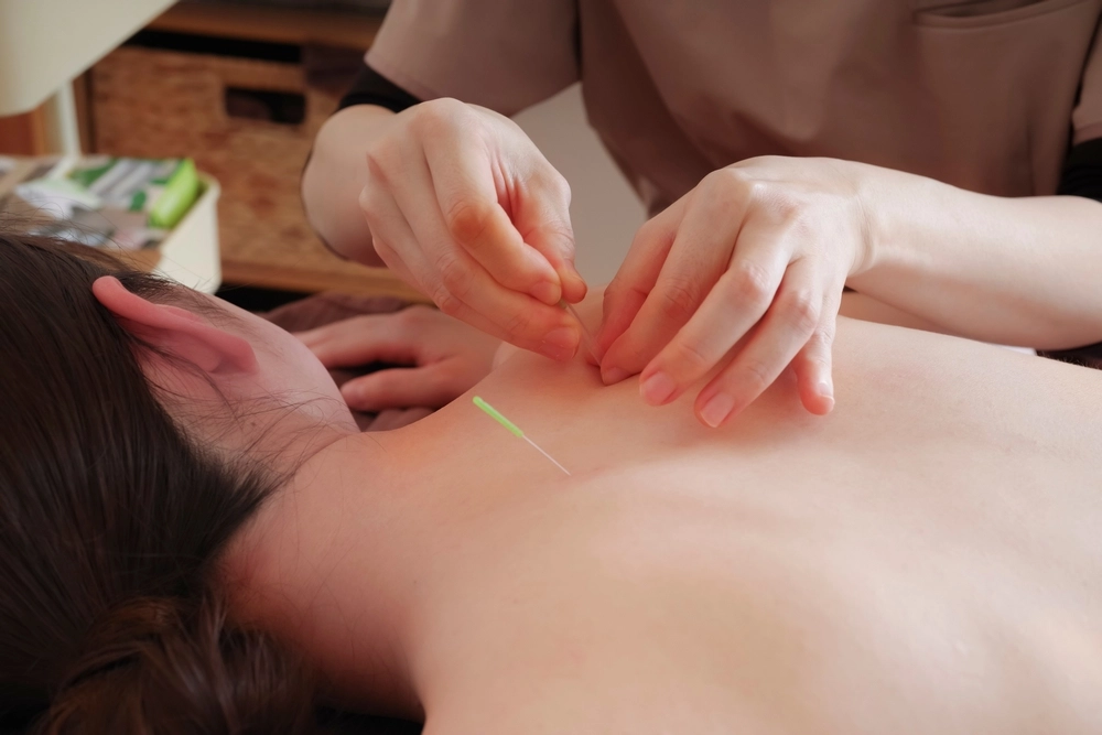 5 Titik Akupuntur Paling Efektif untuk Sakit Kepala